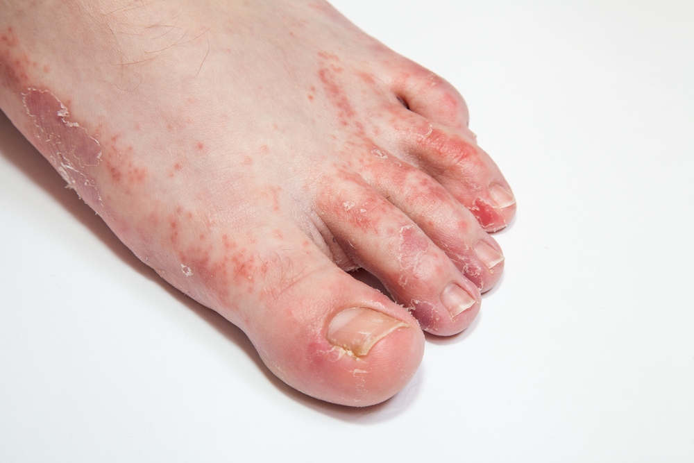 红斑丘疹脱屑瘙痒水疱真菌感染皮肤病如何应对